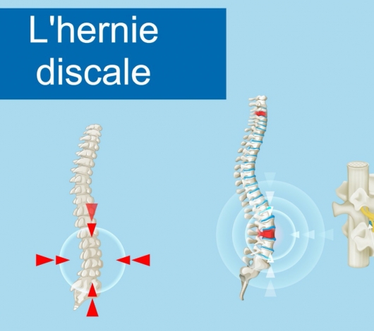 Ozonotherapie : thérapie innovante pour le traitement d’une hernie discale